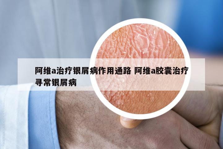 阿维a治疗银屑病作用通路 阿维a胶囊治疗寻常银屑病