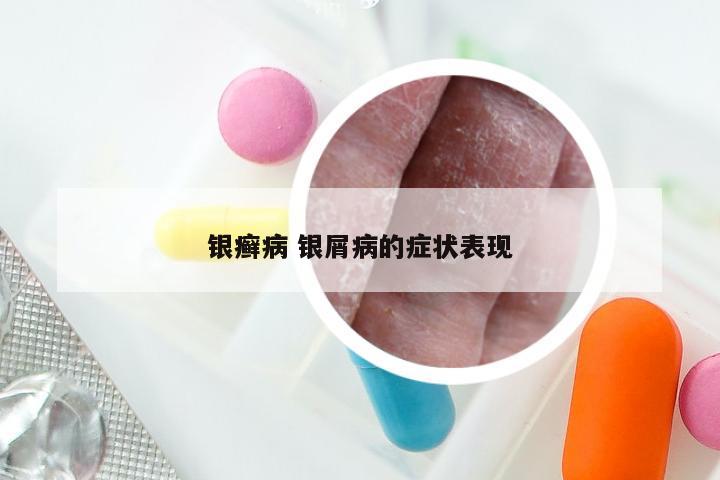 银癣病 银屑病的症状表现