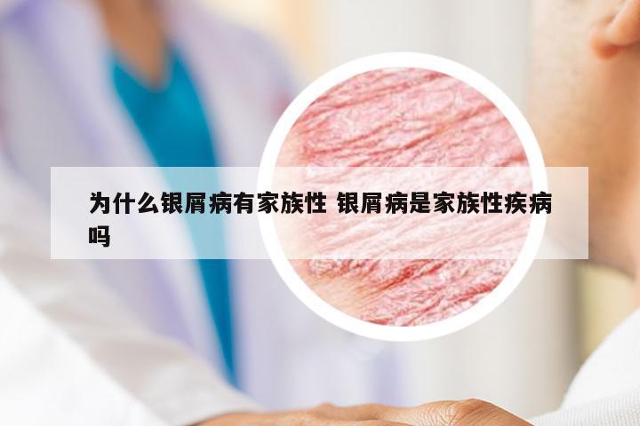 为什么银屑病有家族性 银屑病是家族性疾病吗