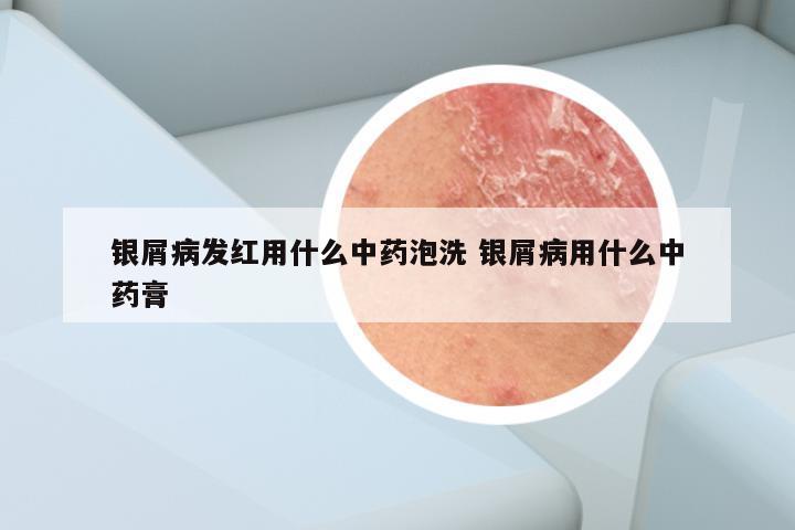 银屑病发红用什么中药泡洗 银屑病用什么中药膏