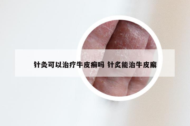 针灸可以治疗牛皮癣吗 针炙能治牛皮廨