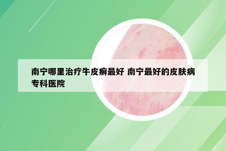 南宁哪里治疗牛皮癣最好 南宁最好的皮肤病专科医院