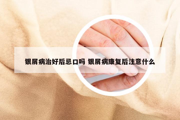 银屑病治好后忌口吗 银屑病康复后注意什么