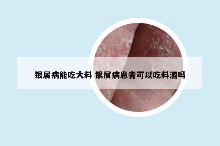 银屑病能吃大料 银屑病患者可以吃料酒吗