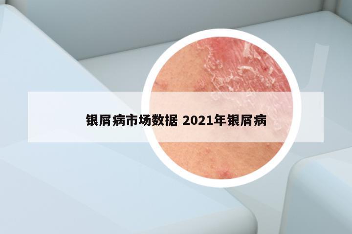 银屑病市场数据 2021年银屑病