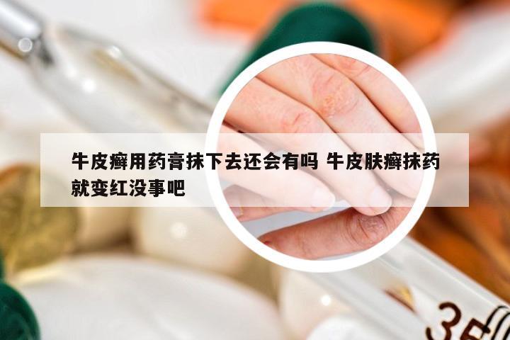 牛皮癣用药膏抹下去还会有吗 牛皮肤癣抹药就变红没事吧