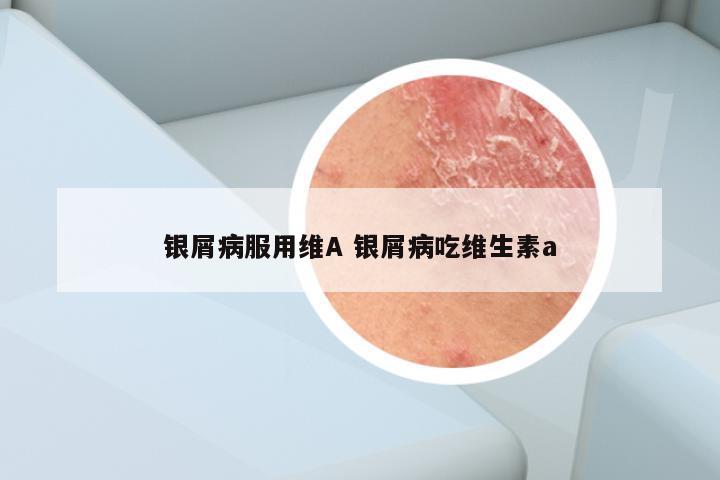 银屑病服用维A 银屑病吃维生素a