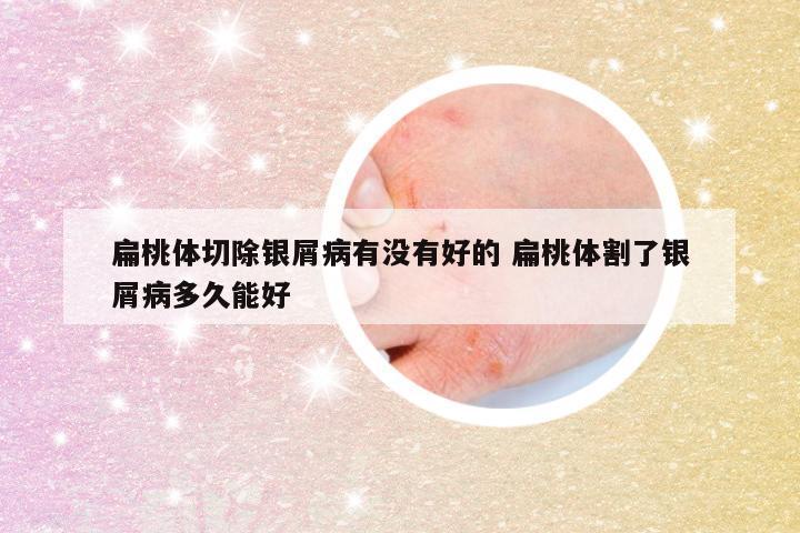 扁桃体切除银屑病有没有好的 扁桃体割了银屑病多久能好