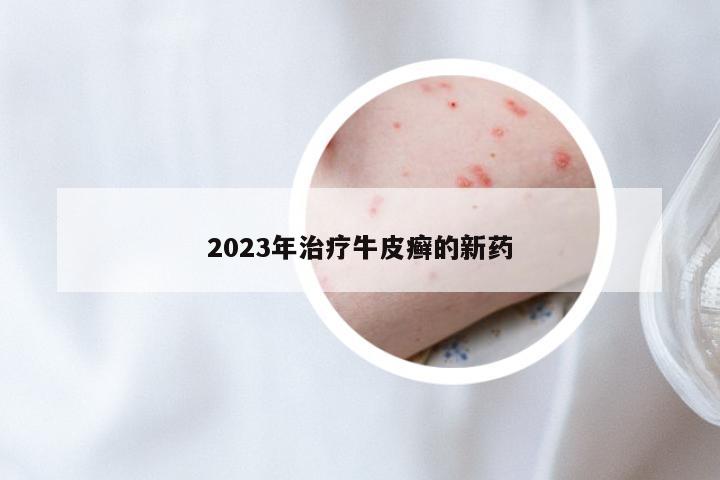 2023年治疗牛皮癣的新药