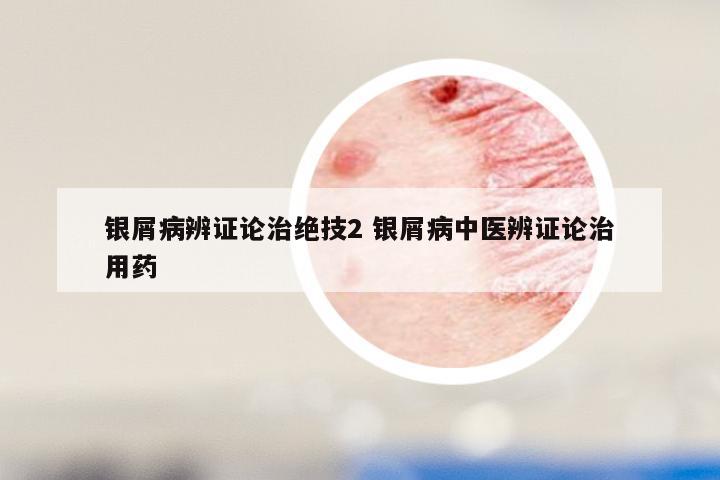 银屑病辨证论治绝技2 银屑病中医辨证论治用药