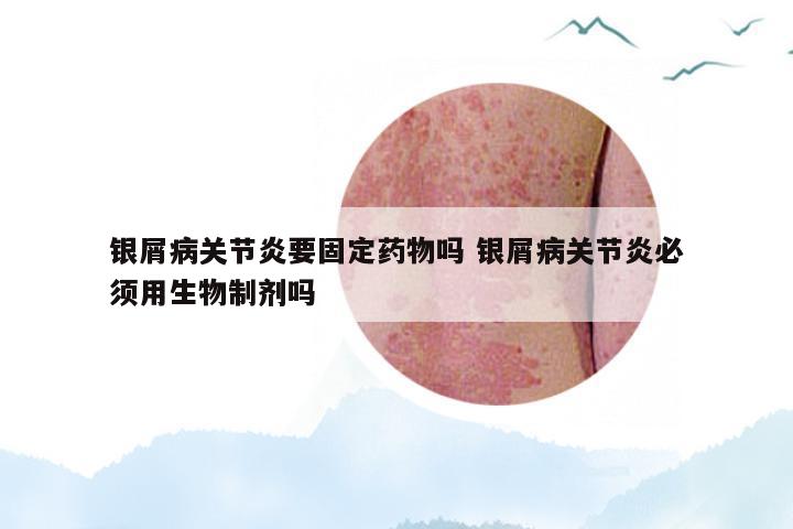 银屑病关节炎要固定药物吗 银屑病关节炎必须用生物制剂吗