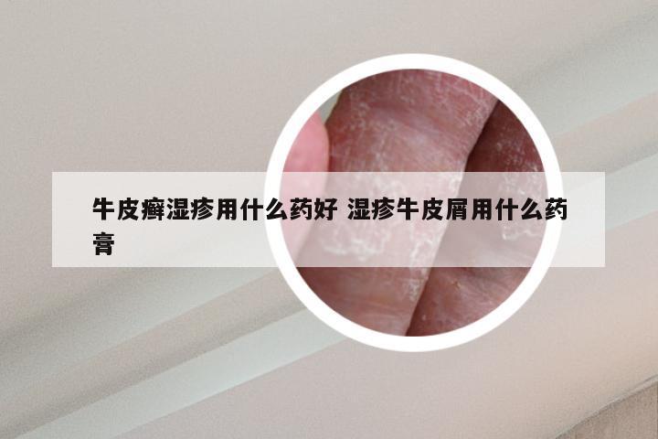 牛皮癣湿疹用什么药好 湿疹牛皮屑用什么药膏