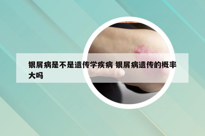 银屑病是不是遗传学疾病 银屑病遗传的概率大吗