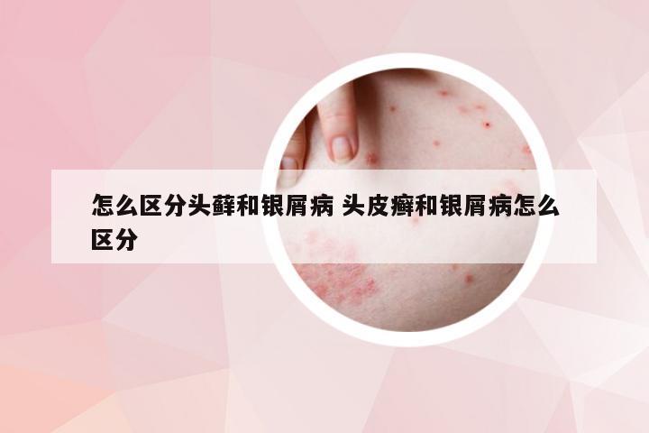 怎么区分头藓和银屑病 头皮癣和银屑病怎么区分