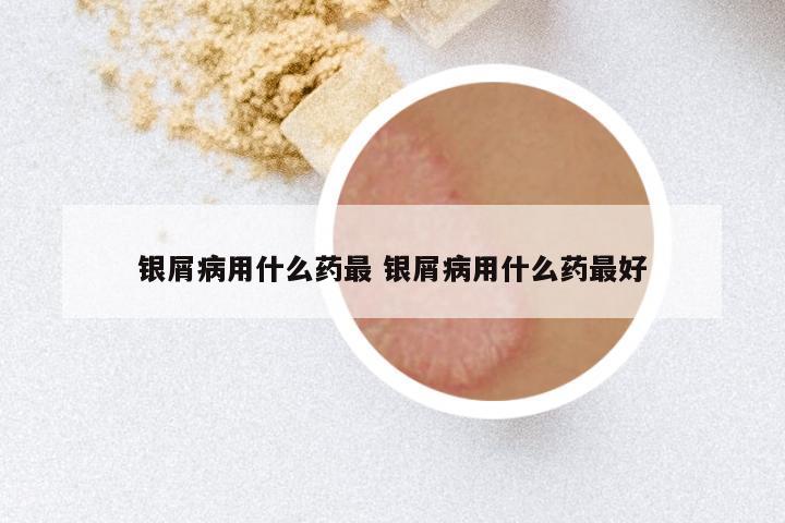 银屑病用什么药最 银屑病用什么药最好