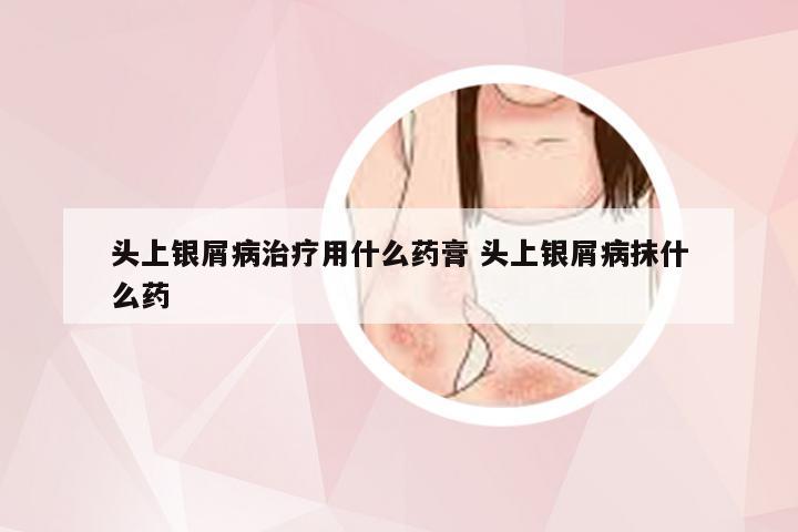 头上银屑病治疗用什么药膏 头上银屑病抹什么药