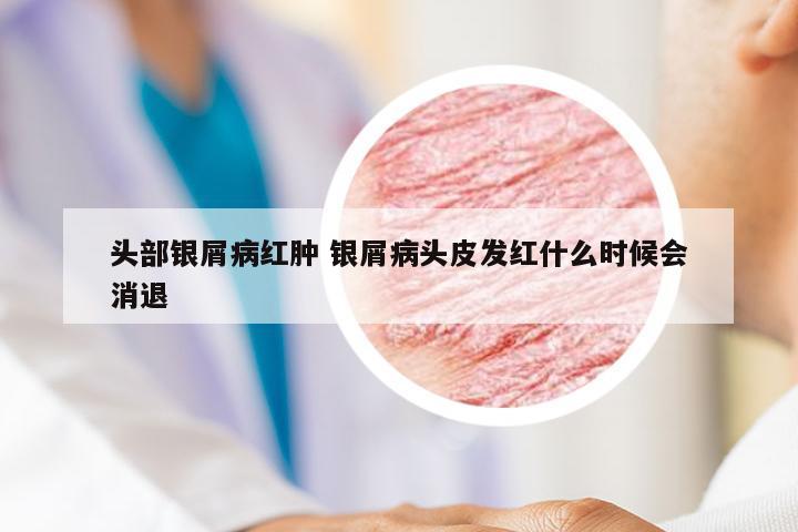 头部银屑病红肿 银屑病头皮发红什么时候会消退