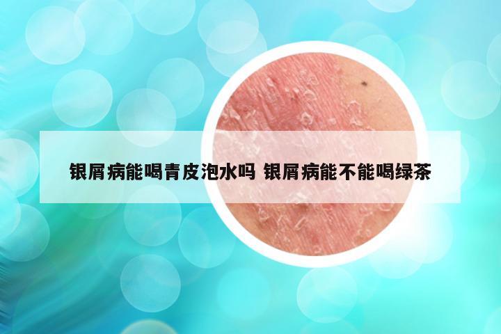 银屑病能喝青皮泡水吗 银屑病能不能喝绿茶