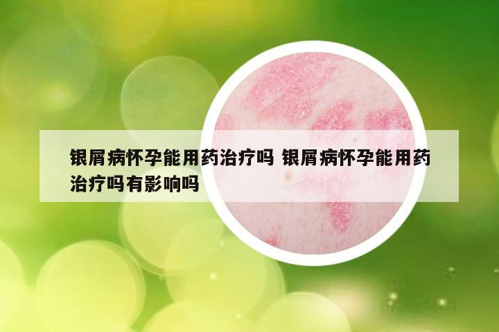 银屑病怀孕能用药治疗吗 银屑病怀孕能用药治疗吗有影响吗