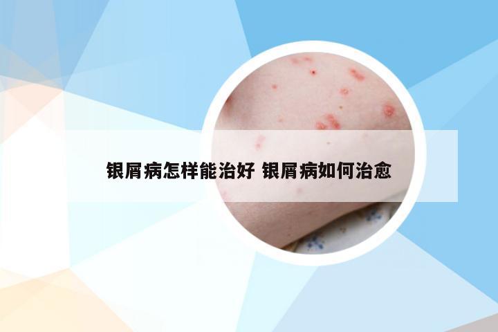 银屑病怎样能治好 银屑病如何治愈