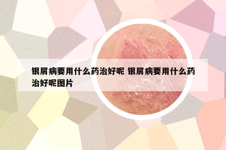 银屑病要用什么药治好呢 银屑病要用什么药治好呢图片