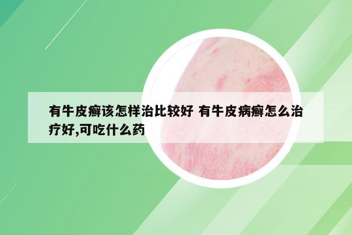 有牛皮癣该怎样治比较好 有牛皮病癣怎么治疗好,可吃什么药