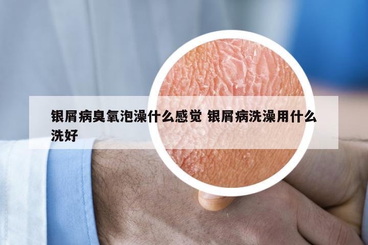 银屑病臭氧泡澡什么感觉 银屑病洗澡用什么洗好