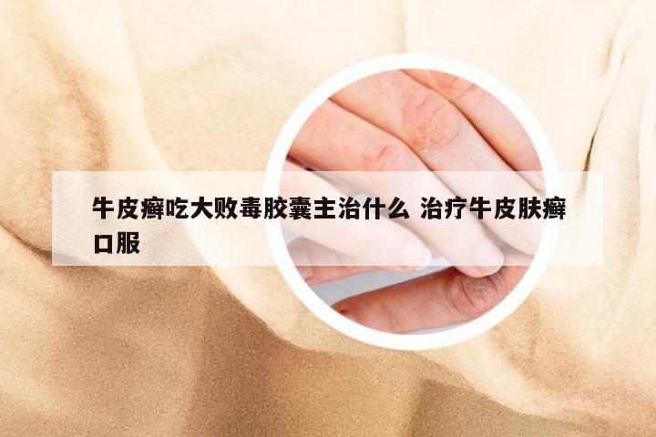 牛皮癣吃大败毒胶囊主治什么 治疗牛皮肤癣口服