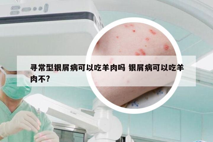 寻常型银屑病可以吃羊肉吗 银屑病可以吃羊肉不?