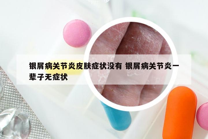 银屑病关节炎皮肤症状没有 银屑病关节炎一辈子无症状