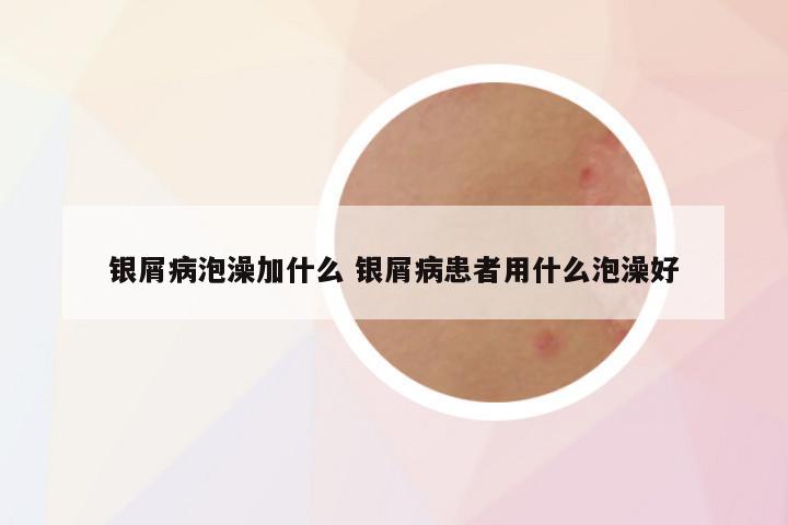 银屑病泡澡加什么 银屑病患者用什么泡澡好