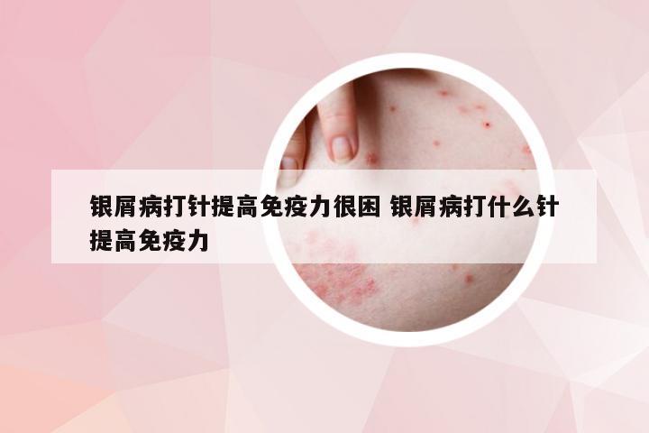 银屑病打针提高免疫力很困 银屑病打什么针提高免疫力