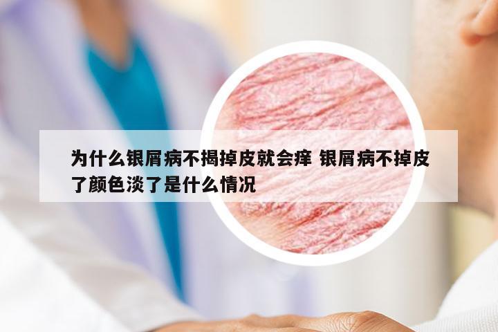 为什么银屑病不揭掉皮就会痒 银屑病不掉皮了颜色淡了是什么情况