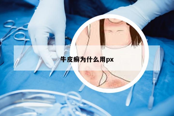 牛皮癣为什么用px